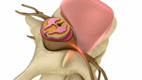 Prolapse of intervertebral disc